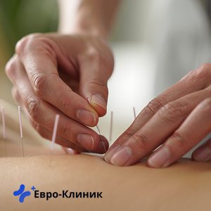 Процесс лечения алкоголизма иглоукалыванием